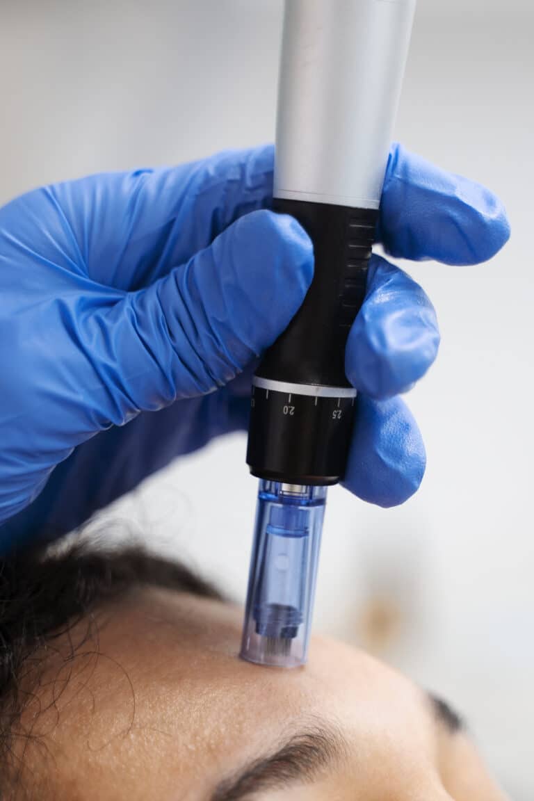 SkinPen - Microneedling