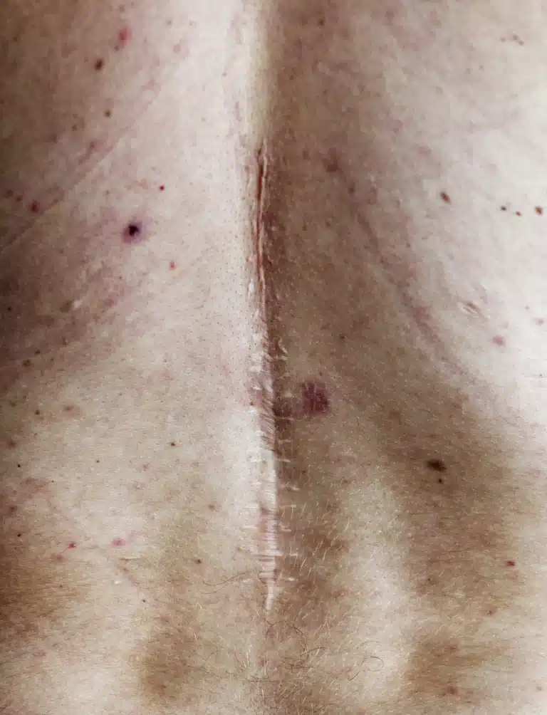 Frax laserbehandling af ar, rynker og strækmærker